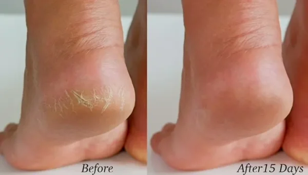 Crafted Tea Tree Salve - Foot Care, Nourish, Anti-Fungal - 2 oz