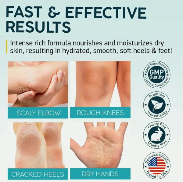 Urea Lotion 40% for Feet - 2% Salicylic Acid - Jar