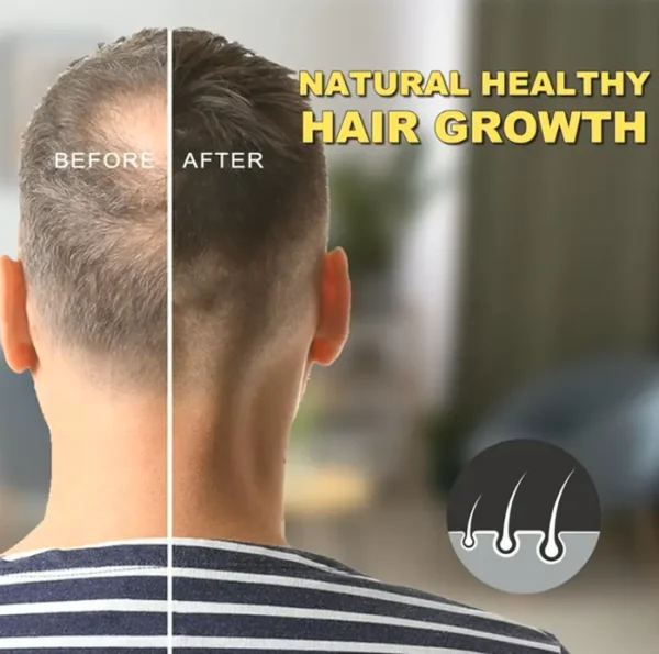 Hair Oil with 5% Minoxidil for Men